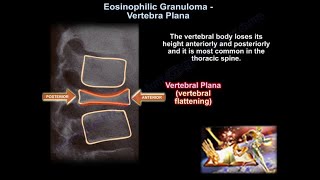 Eosinophilic Granuloma Vertebral Plana  Everything You Need To Know  Dr Nabil Ebraheim [upl. by Erdnaxela372]