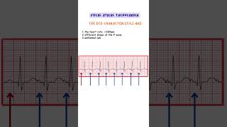 Focal Atrial Tachycardia ecg ecginterpretation medicine doctor nurse [upl. by Warwick]