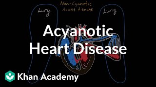 What is acyanotic heart disease  Circulatory System and Disease  NCLEXRN  Khan Academy [upl. by Ivah634]