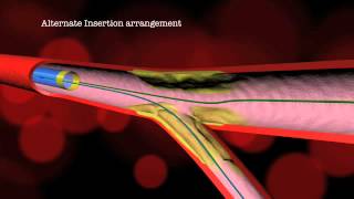 Dedicated Bifurcation Stenting and Alternative Deployment [upl. by Tillinger]