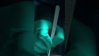 MiniAbdominoplastia  Lipo HD com RETRACTION by Dr Alexandre KRATZ [upl. by Atteugram]