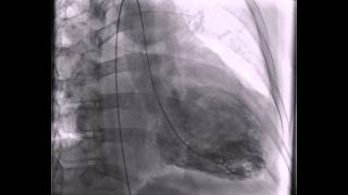 Ventriculogram Myopathy Secondary to Chronic Alcohol Abuse [upl. by Arihsan]