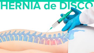 Cuál es el MEJOR TRATAMIENTO para la hernia discal 🦾 Hernia de disco [upl. by Octavie921]