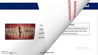 PERIODONTAL CASE HISTORY RECORDING  PART III  Establishing the diagnosis [upl. by Mcnutt16]