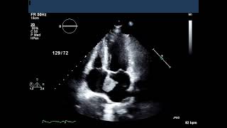 Left Atrial Myxoma TTE [upl. by Atinal]