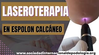 📣LASEROTERAPIA a Espolón Calcáneo Tratamiento Láser 💥 [upl. by Raina157]