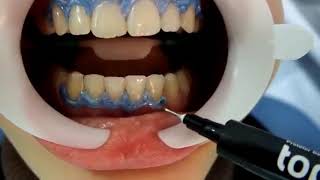 Using FGM Whiteness HP Maxx For In Office Bleaching Tooth Whitening [upl. by Etterb]