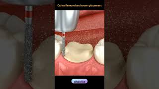 Caries Removal and Crown placementDentalhealth365 shorts shortsvideo dentist [upl. by Rubinstein73]