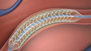 Absorbable Stent [upl. by Georgie]