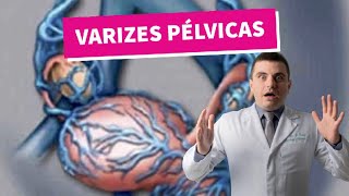 Varizes Pélvicas  no útero e na vulva [upl. by Kella]