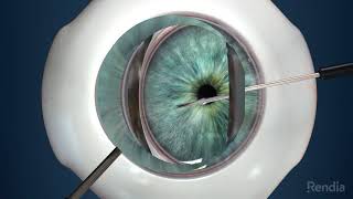 Minimally Invasive Glaucoma Surgical Implant  iStent [upl. by Reinold691]