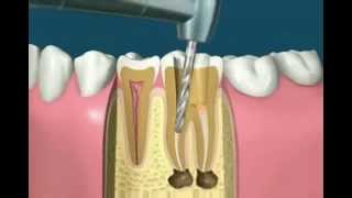 Traitement radiculaire [upl. by Aleras]