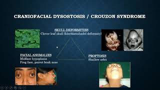 Brief discussion on Crouzon syndrome [upl. by Ttenaej353]