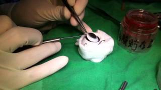 How to harvest cornea button [upl. by Offen]