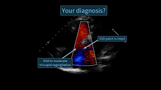 An echocardiographic case of a surgically treated Tetralogy of Fallot [upl. by Selbbep]