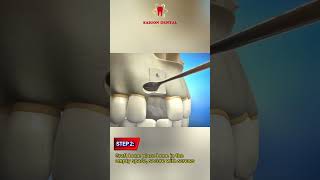 6 Steps of the Autogenous Bone Grafting Process for Dental Implants dentist dental [upl. by Tandi7]