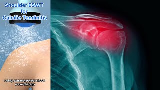 Calcific Tendinitis Of The Shoulder Extracorporeal Shock Wave Therapy May Be The Solution [upl. by Oelc]