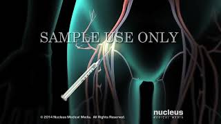 catheter ablation [upl. by Noerb]