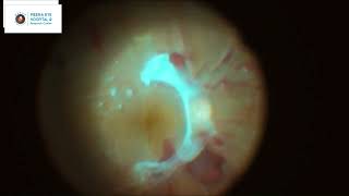 Diabetic Vitrectomy  MEHRC  Dr Ashish K Jain [upl. by Arrakat]