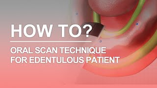 Edentulous Scan DIOnavi Learning Contents [upl. by Nyltiak]