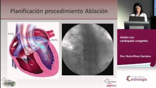 Adulto con cardiopatía congénita [upl. by Aggi173]