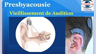 Presbyacousie Audition Physiologie interprétation audiogramme comment devenir sourd test vocal tonal [upl. by Zetnahs793]