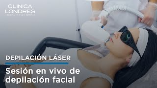 Depilación láser facial sesión con paciente real [upl. by Eelyek]