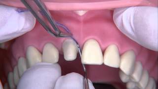 Rétraction gingivale et empreinte définitive [upl. by Brandais]