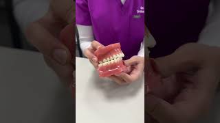 Got a Crossbite Learn How to Tackle It with Professional Care [upl. by Tareyn]