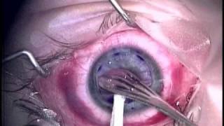 Corneal Transplant 1 [upl. by Avraham447]