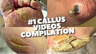 Super Crusty Callus Removal Compilation So Satisfying [upl. by Deland]