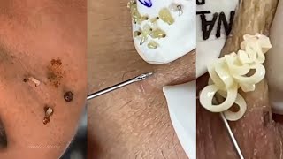 Satisfying Blackhead Extraction Compilation  Deep Pore Cleansing and Acne Treatment [upl. by Cinomod]