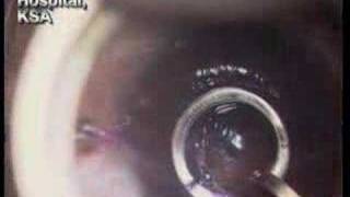 Intracorneal rings for keratoconus [upl. by Veradia524]