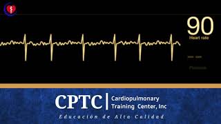 Fibrilación Atrial [upl. by Leopoldeen]