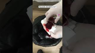 hacamat hacamatsülük hacamatsaglıktır hacamatolunşifabulun👍😊 hacamatsülüktedavisi hijama [upl. by Lenahs]