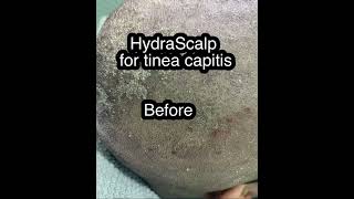 HydraScalp for tinea capitisseborrheic dermatitis [upl. by Marelda]