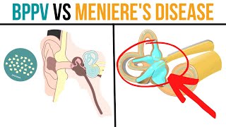 BPPV vs Menieres Disease Whats the Difference amp How to Improve [upl. by Dlareg868]