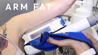 How to reduce arm fat  Fat Freezing [upl. by Mellicent]