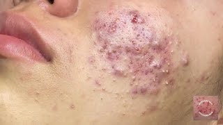 Inflammatory acne is a type of skin acne that often comes with swelling redness and pus [upl. by Isnyl]