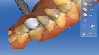 IMPLANT ABUTMENT amp CROWN BY CEREC INLAB [upl. by Waddle]