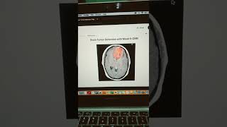 Brain Tumour Detection [upl. by Blaze]