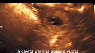 MED2000ECO Gravidanza extrauterina con embrione vivo [upl. by Catherine]