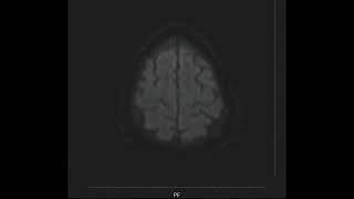 Left Medullary Infarct MRI [upl. by Bernhard]