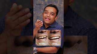 അര മണിക്കൂറിൽ പല്ല് ശെരിയാക്കാം dentalclinic dentaltips dentalcrowns dentalveneers smile [upl. by Anowahs867]