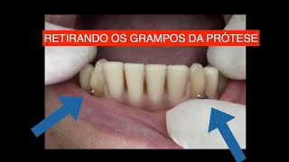 DENTADURA HÍBRIDA APOIADA EM IMPLANTES E DENTES [upl. by Ailadgim468]