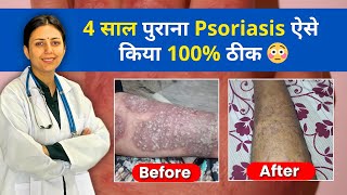 Psoriasis को कैसे ठीक करें  Skin Psoriasis Treatment  Dr Upasana Vohra Patient Review [upl. by Hadden]