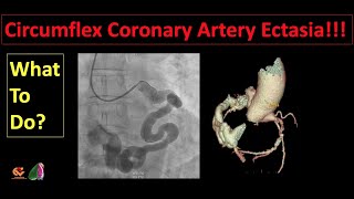 Circumflex Coronary Artery Ectasia What To Do [upl. by Eipper]