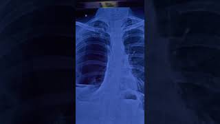 Hydropneumothorax  Chest Xray  Opacifiaction Pleural Effusion  Air fluid levels  Collapse lung [upl. by Aremus]