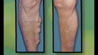 Varicose Vein Treatment by Laser  Endovenous Saphenous Vein Ablation  ELVES [upl. by Sucramal]