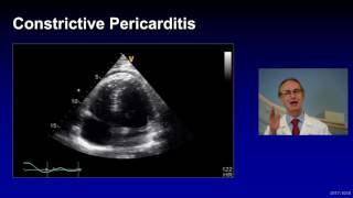 Treatment of Complicated Pericarditis [upl. by Aitnyc]